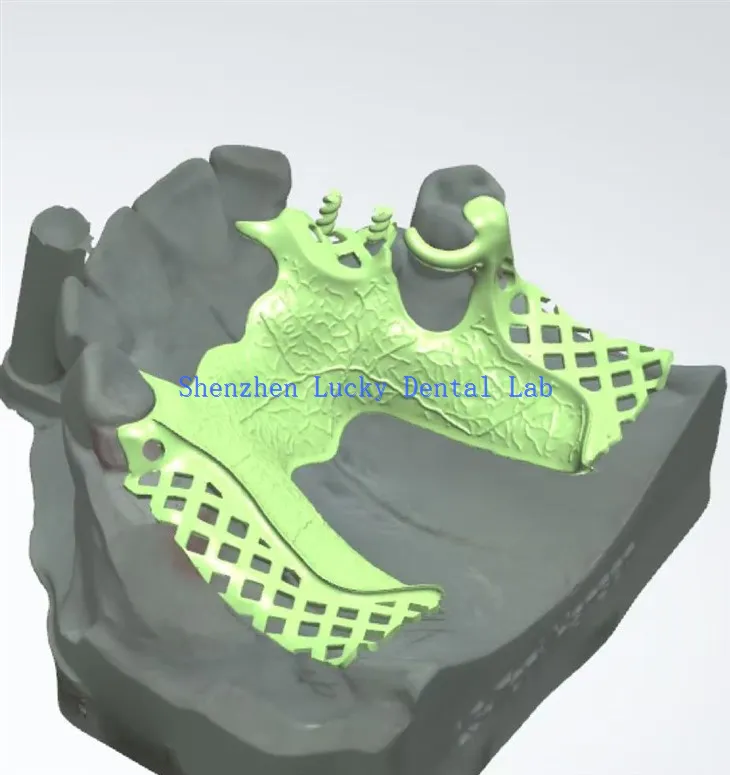 3D nyomtatott fogászati ​​fém keretgyártók