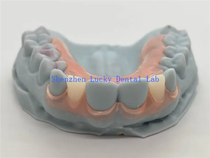 3D Print Dental TCS rugalmas részleges fogpótlások