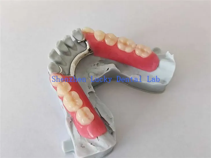 3D nyomtatás Partiális akril fogsor fémkeretrendszer próbálkozás a fogorvosi laboratóriumban
