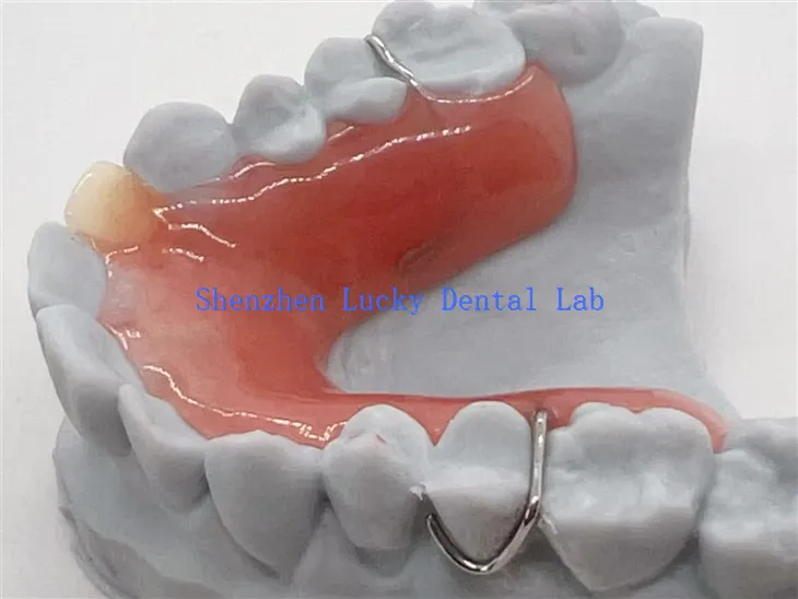3D nyomtatás Kivehető részleges műfogsor akril alappal