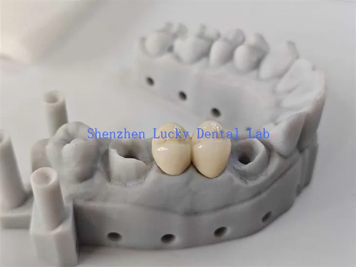 Esztétikai fogászati ​​PFM COCR híd