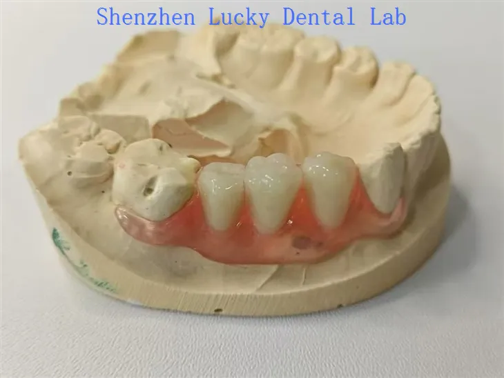 Esztétikai fogorvosi láncfedél