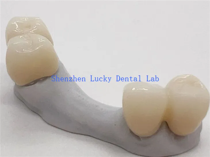 Esztétikai fogászati ​​cirkónia híd