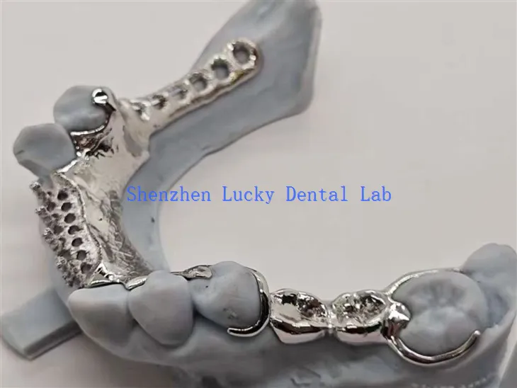 Ötvözet hátú fogazat kialakítása fém vázzal