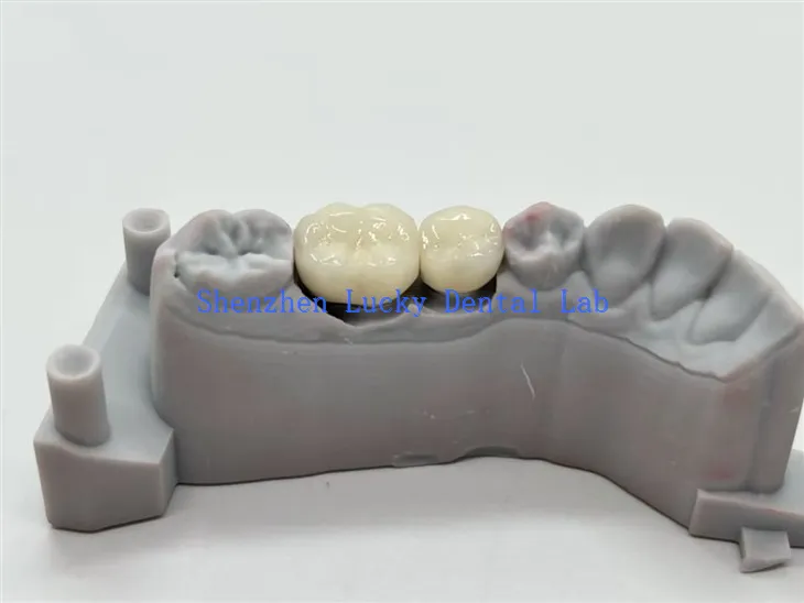 CoCr ötvözet PFM fogászati ​​koronák