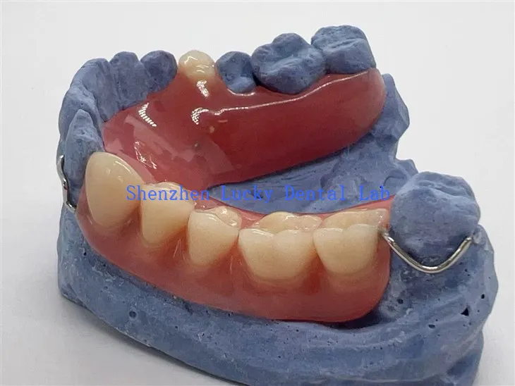 Kényelmes részleges akril fogsor huzalkapaszos