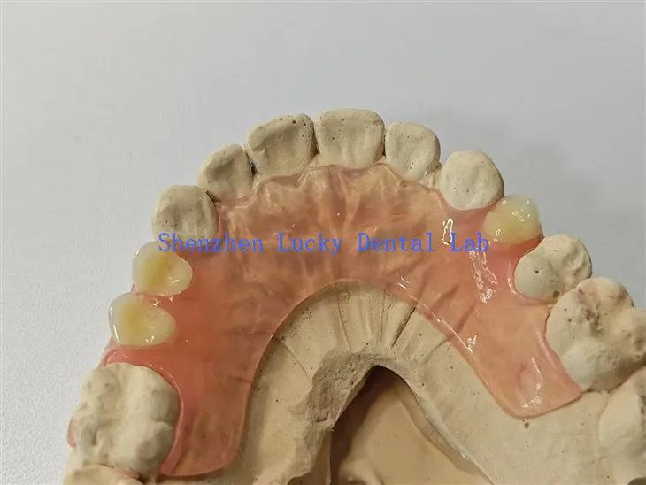 Kényelmes rugalmas fogsor fogorvosi laboratórium