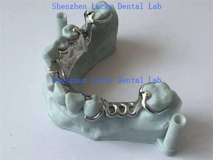3D nyomtatott fém keretrendszer nyelvi tányér fogászati ​​laboratóriummal