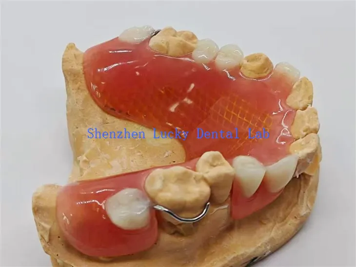 Eltávolítható részleges fogsor fémhálóval