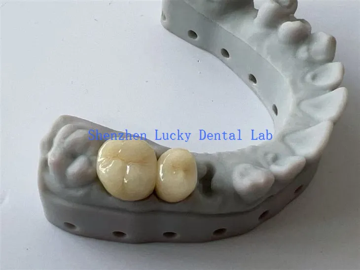 Kiváló minőségű 3D -s nyomtatás PFM COCR Dental Bridge gyártók
