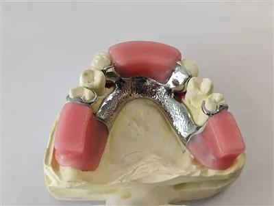 A csavarcsatorna fémkeretrendszerrel és harapás blokkkal történő fogászati ​​precíziós rögzítése