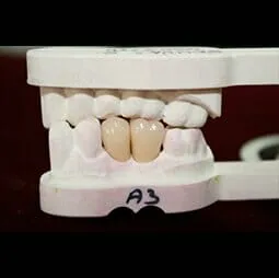 Semi - Precious Metal Palladium - Ezüst korona