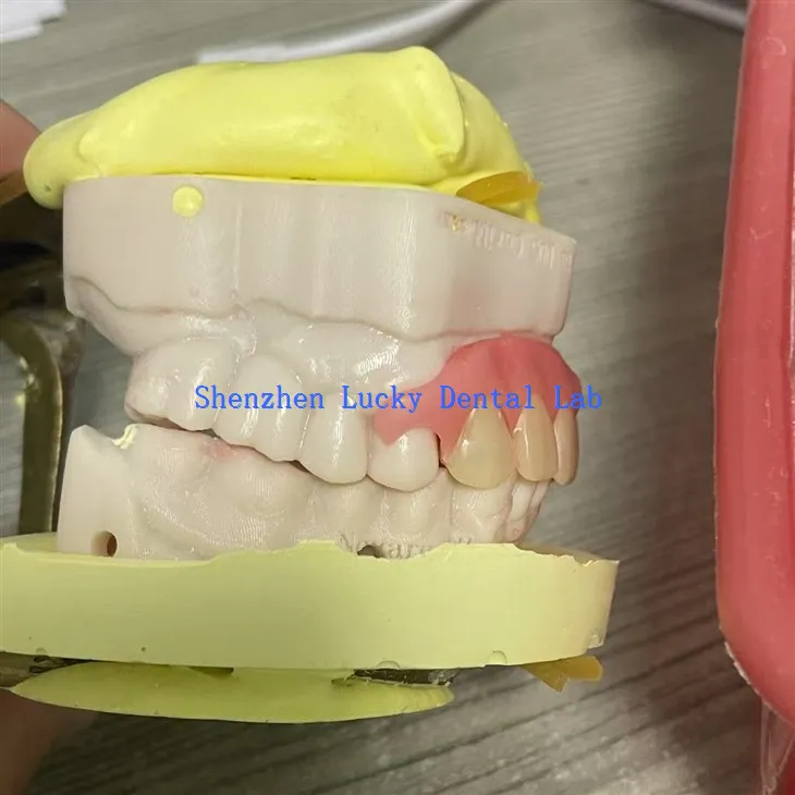 Kényelmes részleges rugalmas fogsor próbálkozás a fogorvosi laboratóriumban