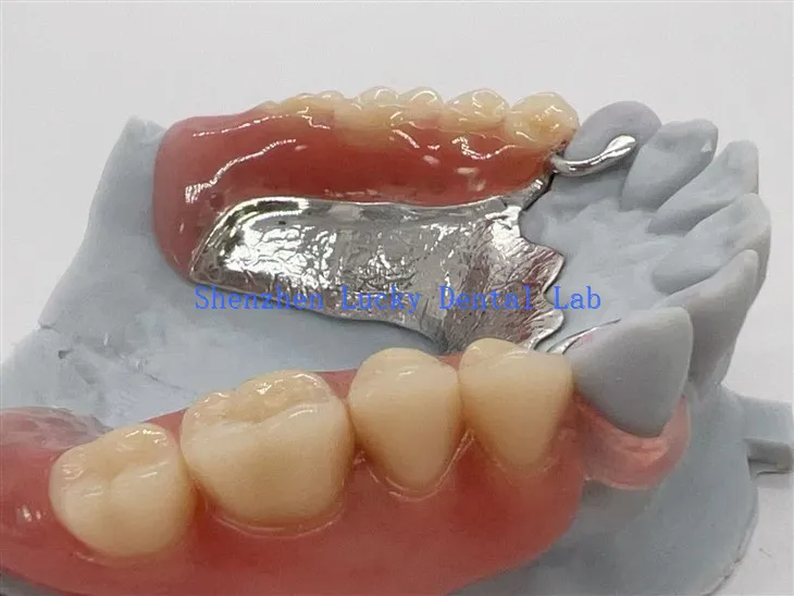 Vallaplast Clasp fémkeret akril fogsorral