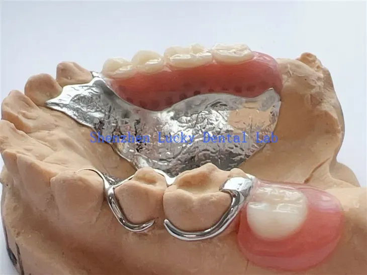 Huzalkapás fogászati fém keret részleges akril fogsorral